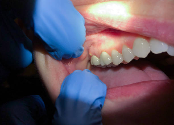 Best Knocked-Out Tooth (Avulsed Tooth) Treatment in Dash Point, WA