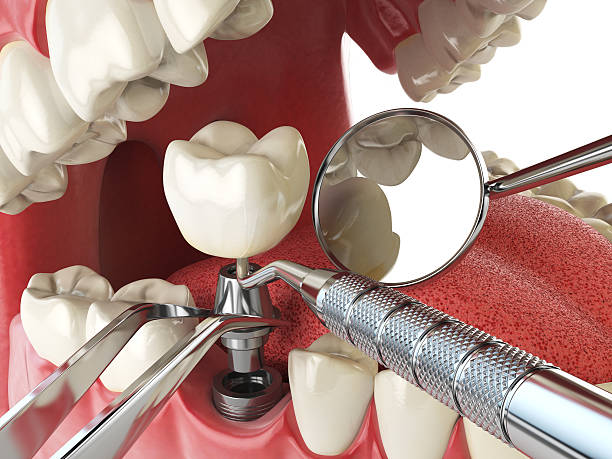 Best Broken or Chipped Tooth Repair in Dash Point, WA